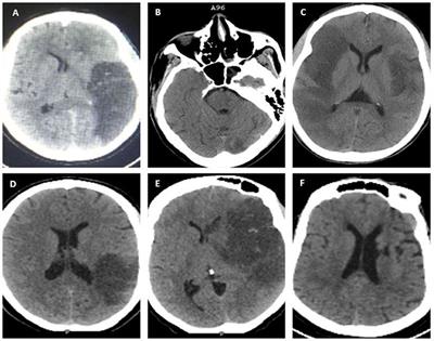 Ischemic Stroke at a Tertiary Academic Hospital in Tanzania: A Prospective Cohort Study With a Focus on Presumed Large Vessel Occlusion